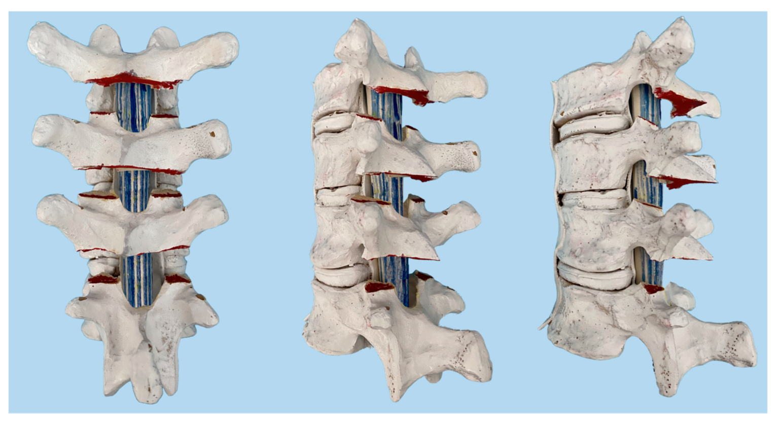 Spinal Osteotomy – Melbourne Orthopaedic Clinic